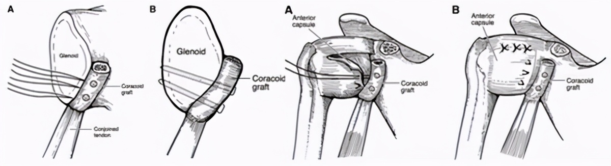 肩关节正斜位怎么治疗,怎么判断肩关节稳定不稳定