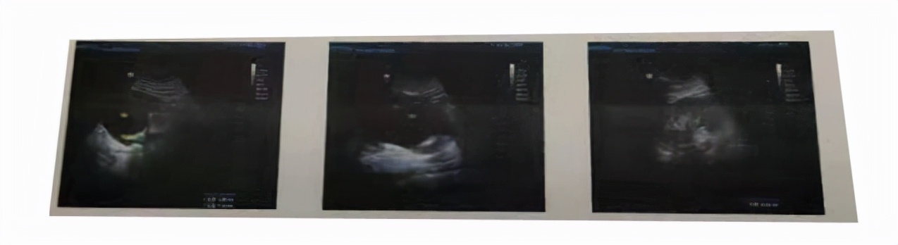 男性肾结石掉到输尿管了怎么排,左肾积水左输尿管结石严重吗