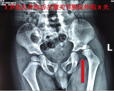 小孩髋关节脱臼复位手法视频,宝宝髋关节脱位可以正骨复位吗