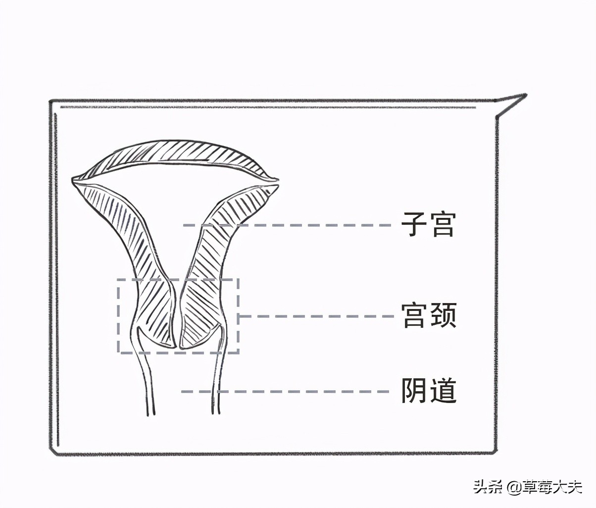 「人气案例」宫颈癌手术就得终生挂尿袋生活？草莓医院专家SayNo