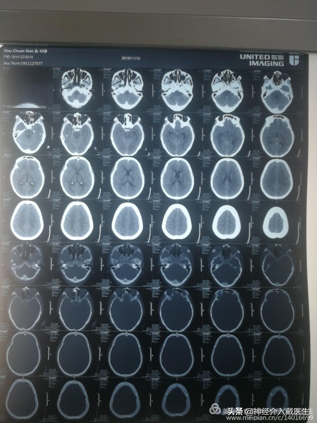 神经外科手术动脉瘤,湖南省人民医院脑动脉瘤介入治疗