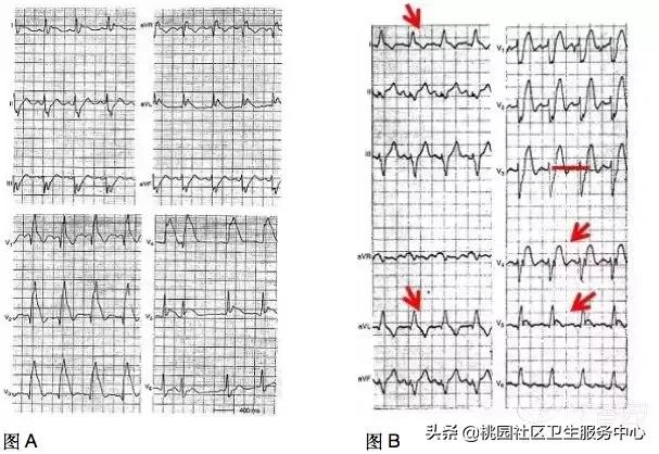 早期心梗心电图能查出来吗,警惕这种要命的心电图表现