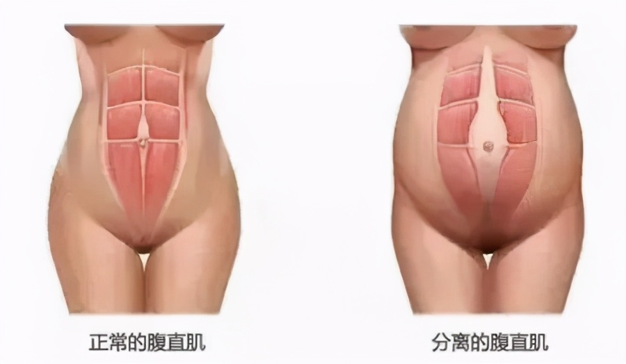 三指半到闭合,一个双胞胎妈妈的腹直肌康复之路