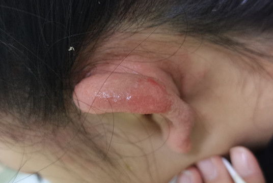 冻伤该如何处理,液氮冻伤处理方法