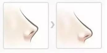 隆鼻能坚持到老吗,隆鼻的潜规则有哪些