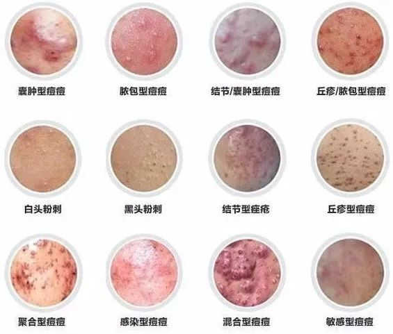 脸上不同部位长痘对应器官有问题,脸上长痘部位对应内脏