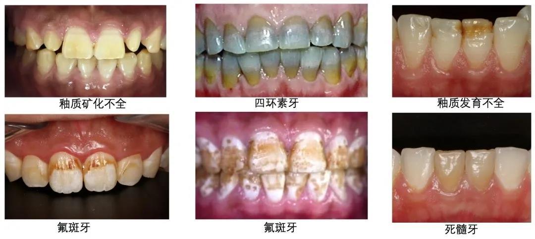 哪个牌子的牙齿美白贴片效果最好,目前最安全有效的牙齿美白