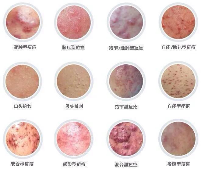 十年战痘肌自救指南,十年痘肌怎么抗痘