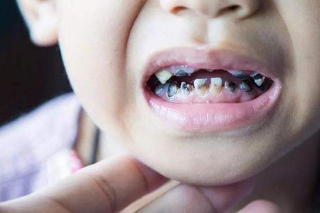 三岁孩子大牙是虫牙怎么办,3岁孩子满口都是黑牙