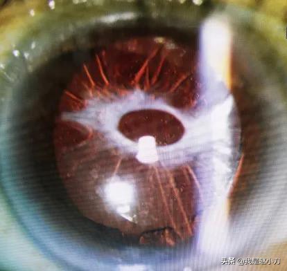 超高度近视手术恢复到正常近视,超高度近视建议做近视手术么