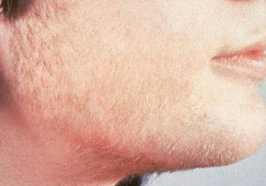 意大利女子牙龈长出睫毛状毛发,历经8年未治愈,病因很常见