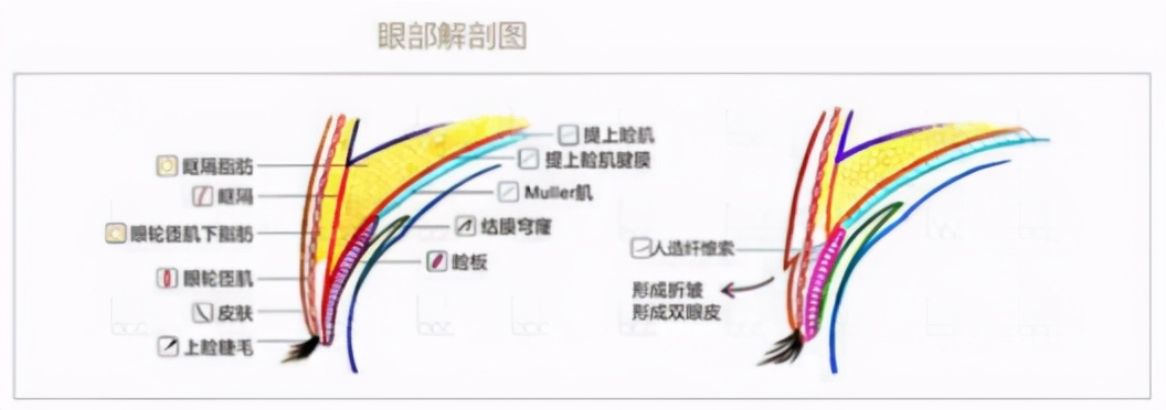 双眼皮宽深修复后三眼皮案例,修复假宽深双眼皮最好的医院