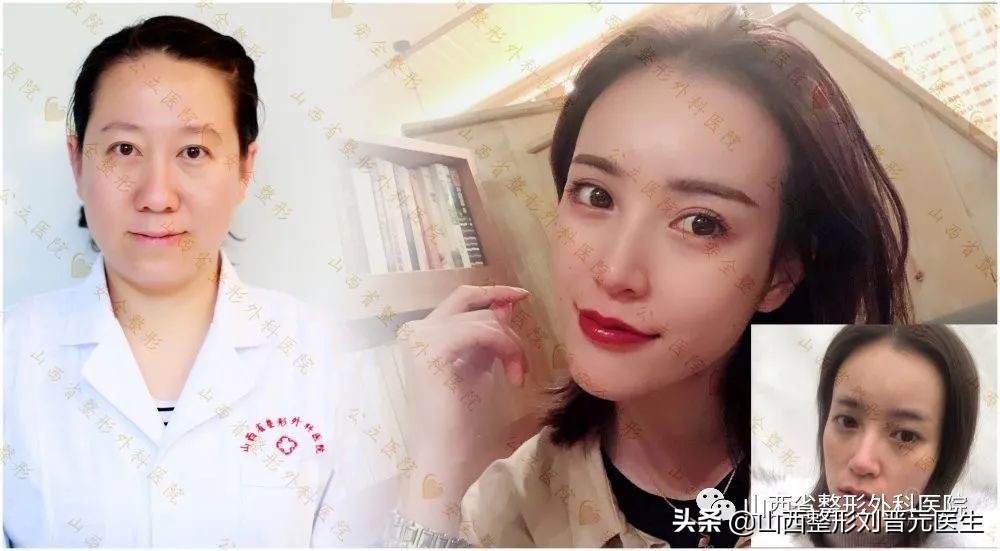 埋线抽脂双眼皮二十天了还不自然,8.5毫米的埋线双眼皮自然吗