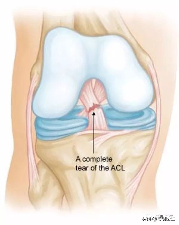 前交叉韧带损伤,ACLInjuries原因-双语学习