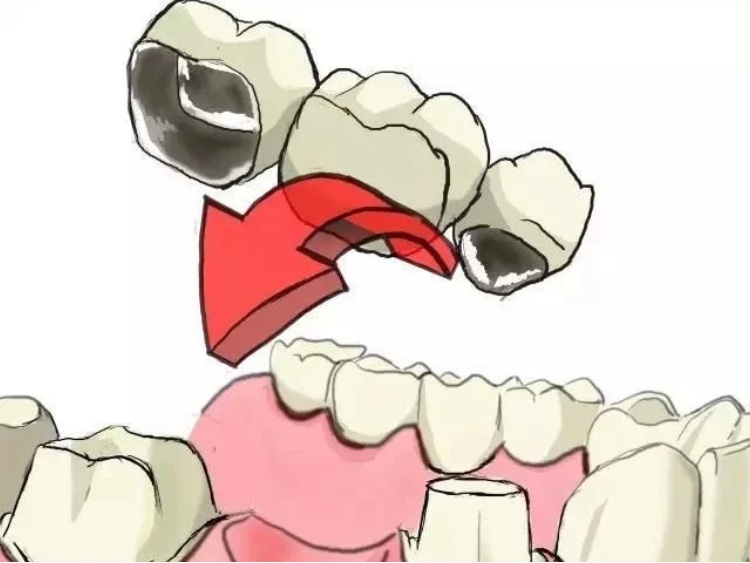 良心牙医不建议拔残根,牙医没拔干净有残根会怎样