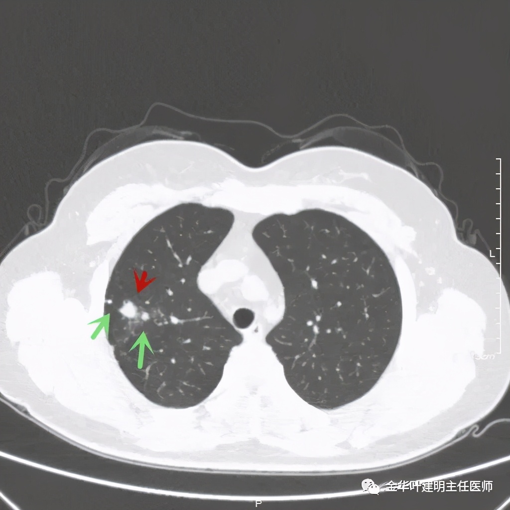 右上肺结节灶一般是什么癌,右上肺恶性肿瘤是肺癌吗