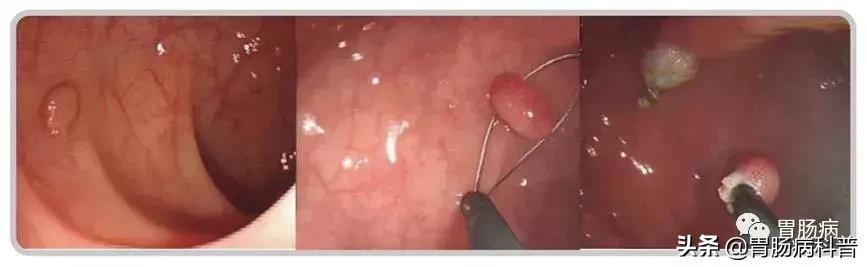 长胃息肉要注意什么,胃长息肉要注意什么