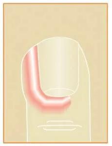 解决甲沟炎比较好的方法,甲沟炎很严重怎么修