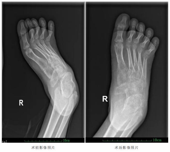 ilizarov技术演示,ilizarov技术手术步骤