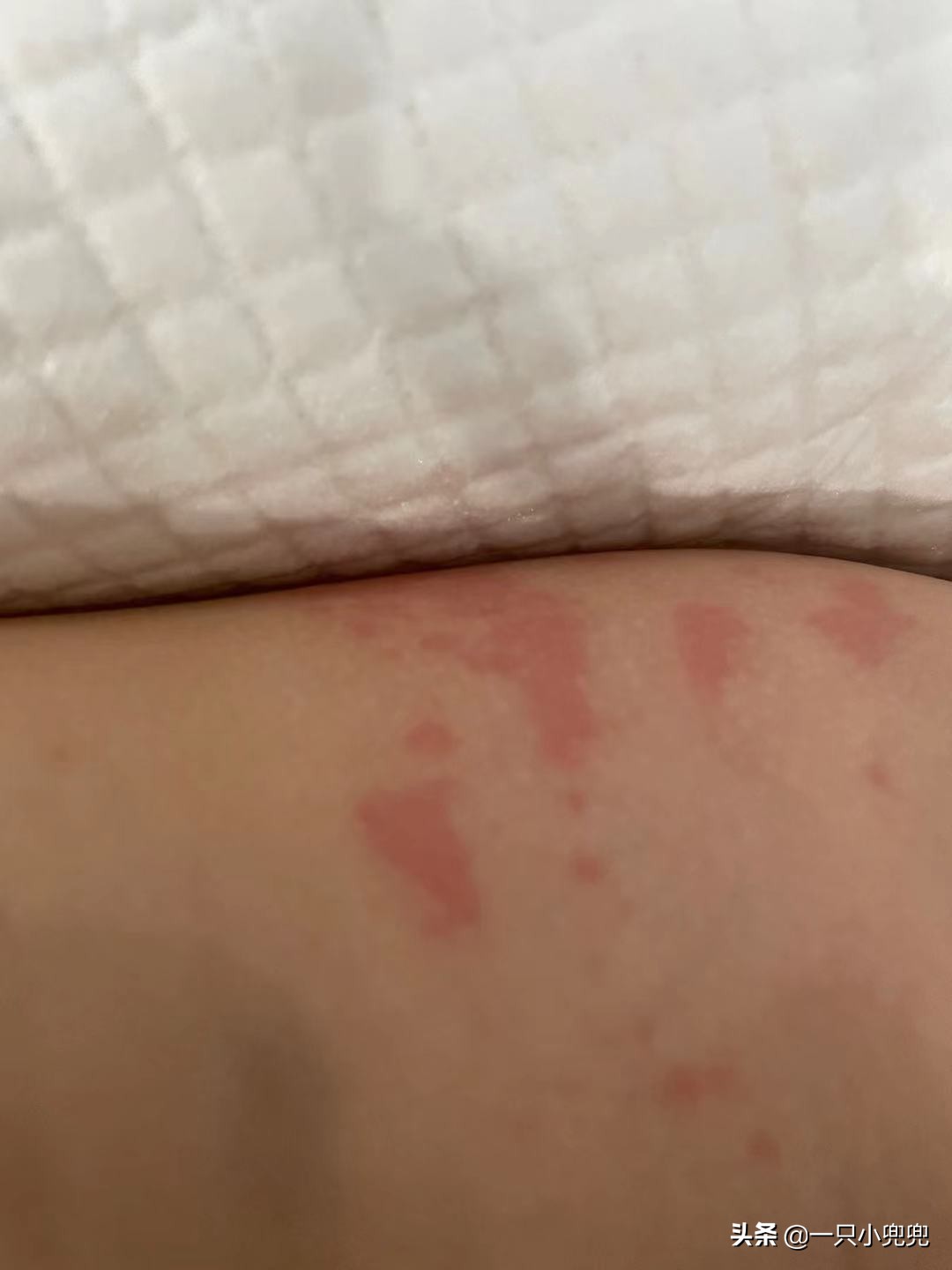 宝宝过敏怎么办六个妙招帮助你,宝宝过敏怎么办看完这篇轻松应对