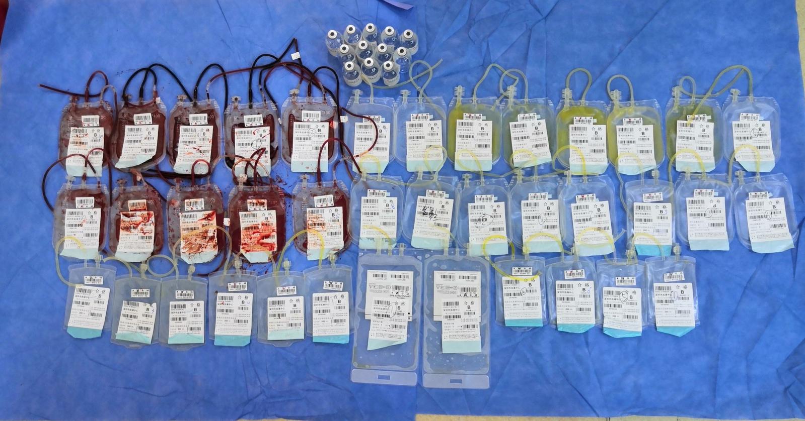 产后大出血产妇抢救,产妇大出血8000毫升后续