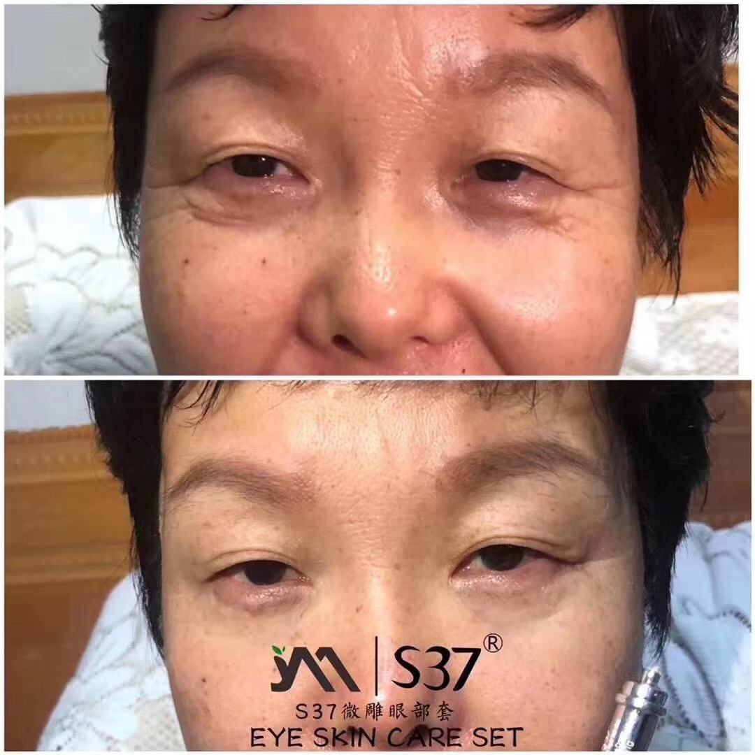 s37微雕眼霜代理,s37微雕眼霜去眼袋