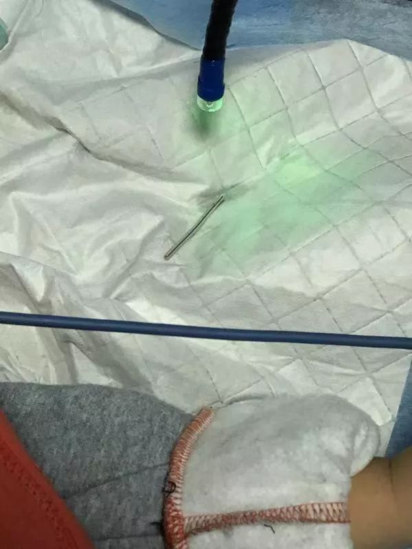 小孩吃棒棒糖乱跑被戳嘴,孩子误吞棒棒糖