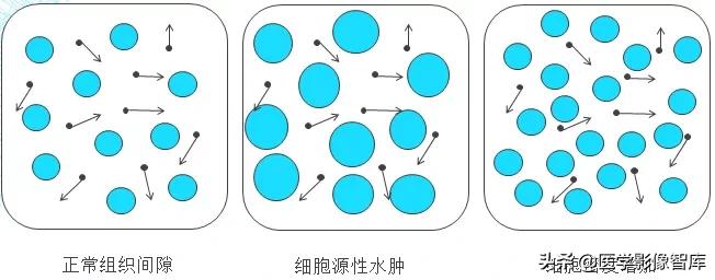 双侧额叶皮层区dwi偏高是什么意思,颅内dwi高信号病变