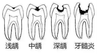 牙齿小洞不补下一句是什么,牙齿小洞不补大洞吃苦的意思