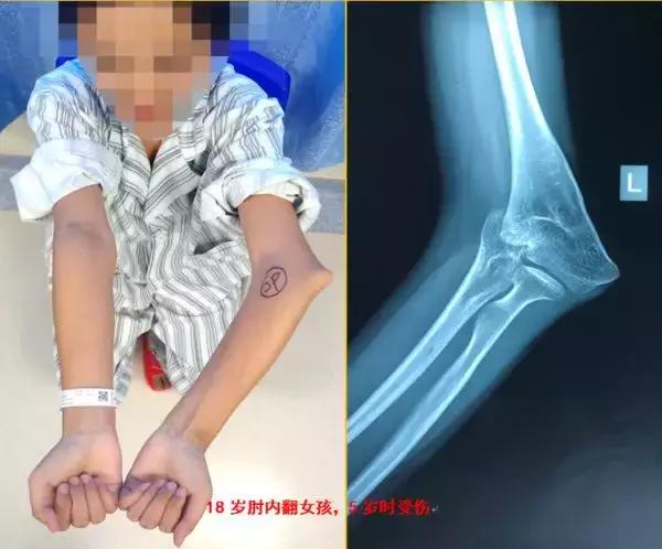 孩子胳膊向外弯怎么回事,小孩胳膊肘往内拐什么原因
