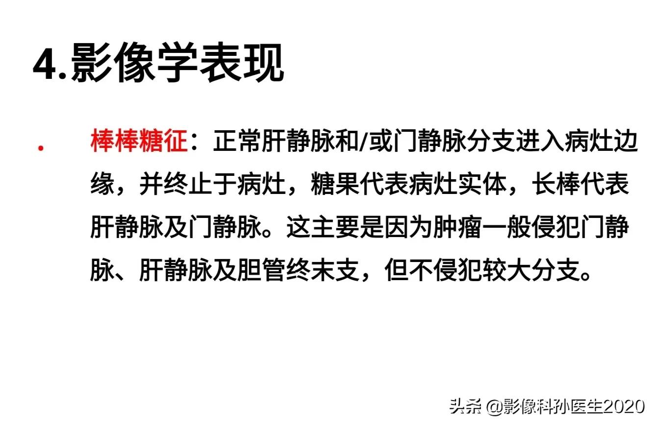肝上皮样血管内皮瘤全国多少例,肝上皮样血管内皮瘤超声表现