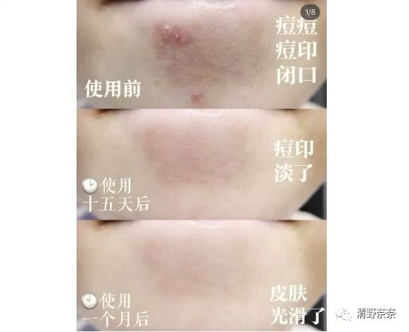 卖爆的*干粉冻**“EGF”要是没有皮损,根本感受不到效果的好嘛?