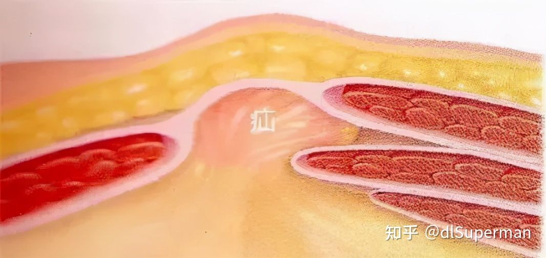 腹股沟疝术后要注意什么,孩子有腹股沟疝应该注意什么