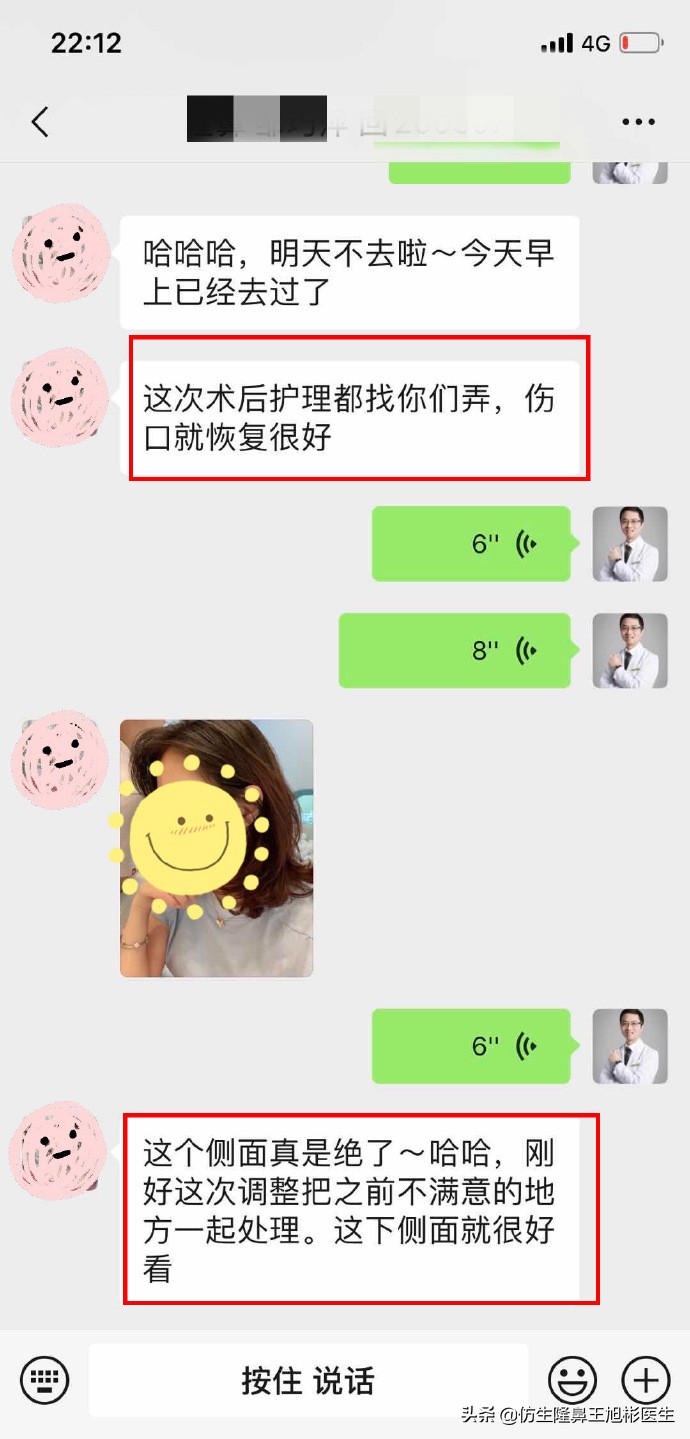 鼻头肥大矫正加鼻翼缩窄案例,鼻头缩小术后