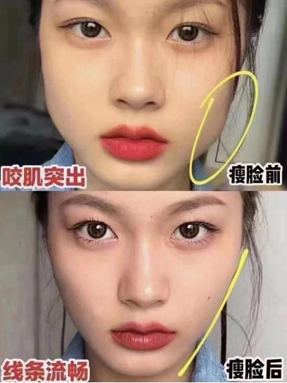 瘦脸针一针就可以达到最佳效果吗,打瘦脸针怎么样才能快速见效