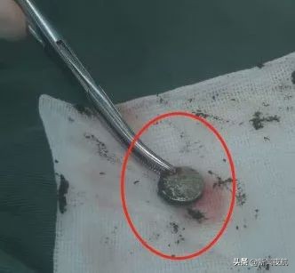 小女孩*体下**塞入异物流血不止！隔了几天走路都不对劲了