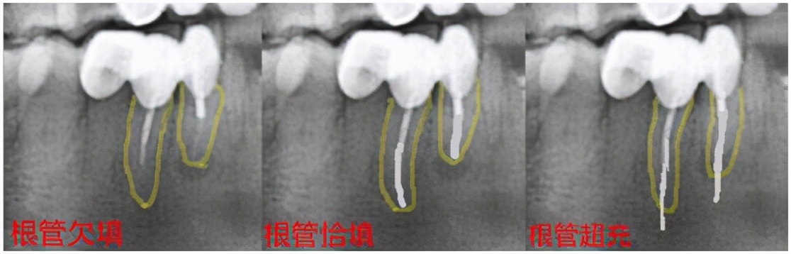 做根管治疗有没有风险,做根管治疗诱发癌症