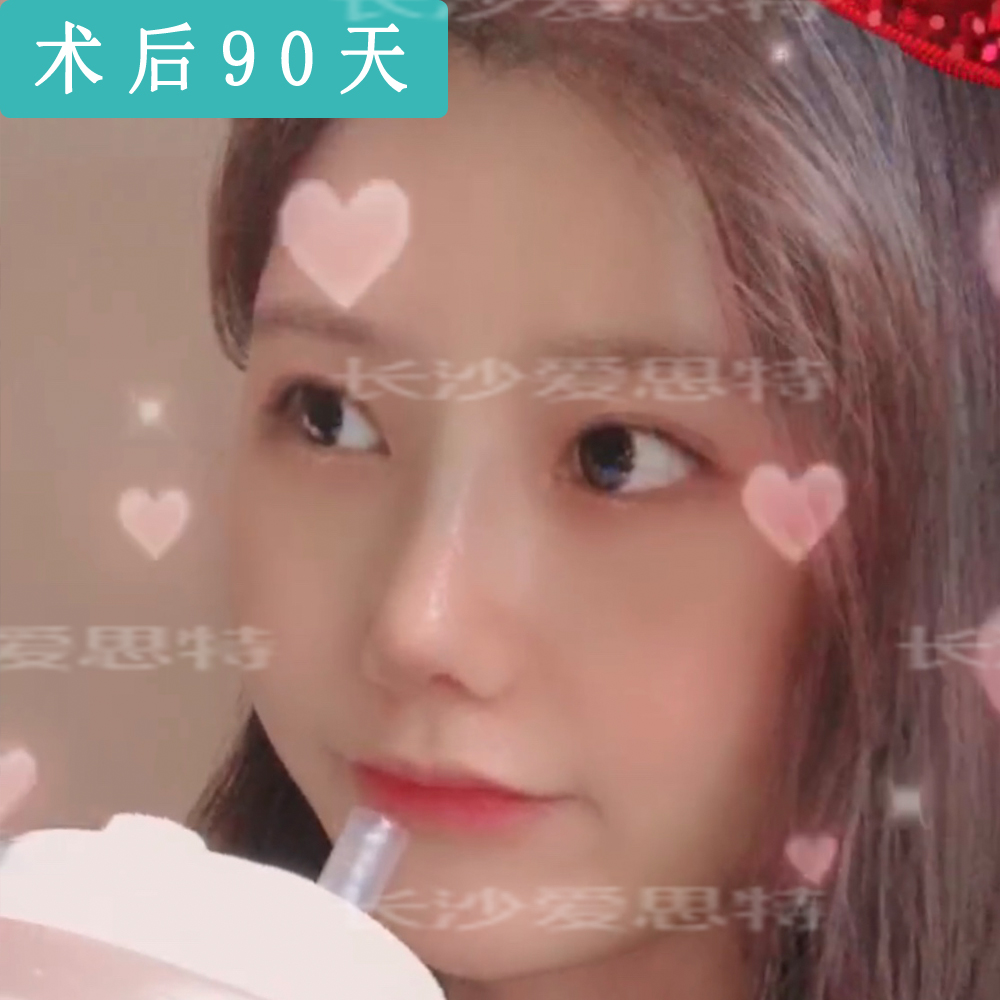 耳软骨隆鼻大概多久恢复正常,隆鼻耳软骨取出后可以恢复原样吗