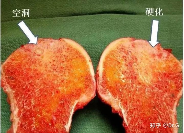 短时间用激素一定会股骨头坏死吗,没服过激素会股骨头坏死吗