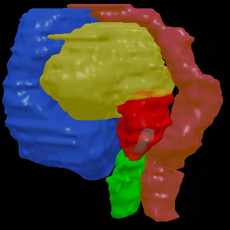 宫颈癌转移到膀胱还能治愈吗,宫颈癌术后病例