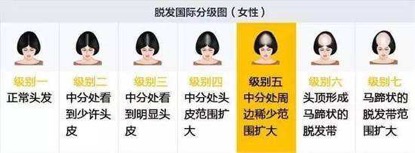 中年妇女脱发如何生发,老公脱发秃头