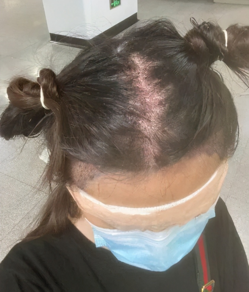 鑴卞彂绉冨鍏舵潵瀹堜綇澶村彂鍒讳笉瀹圭紦,20宀佽劚鍙戝揩绉冧簡