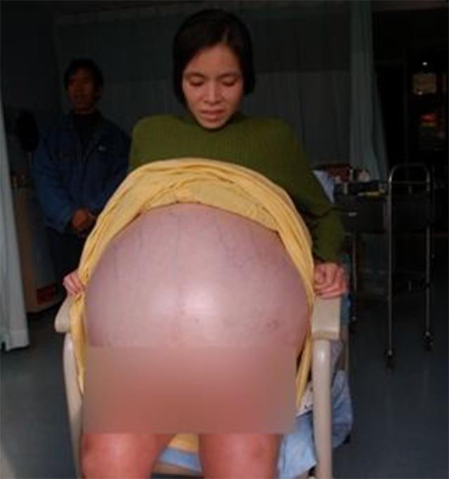 彭细妹为求子尝试偏方：肚子一天天变大，12个月了还没生产