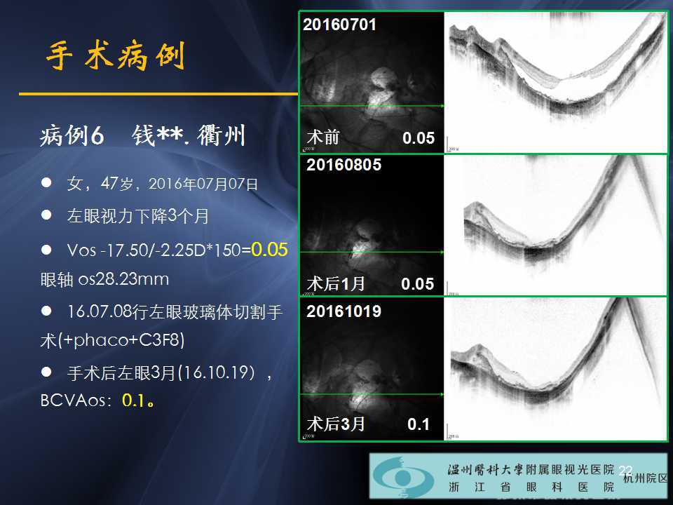 高度近视黄斑劈裂哪家医院好,高度近视黄斑劈裂中医治疗