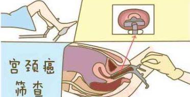 宫颈癌疫苗免费视频,关于宫颈癌疫苗的各种答疑