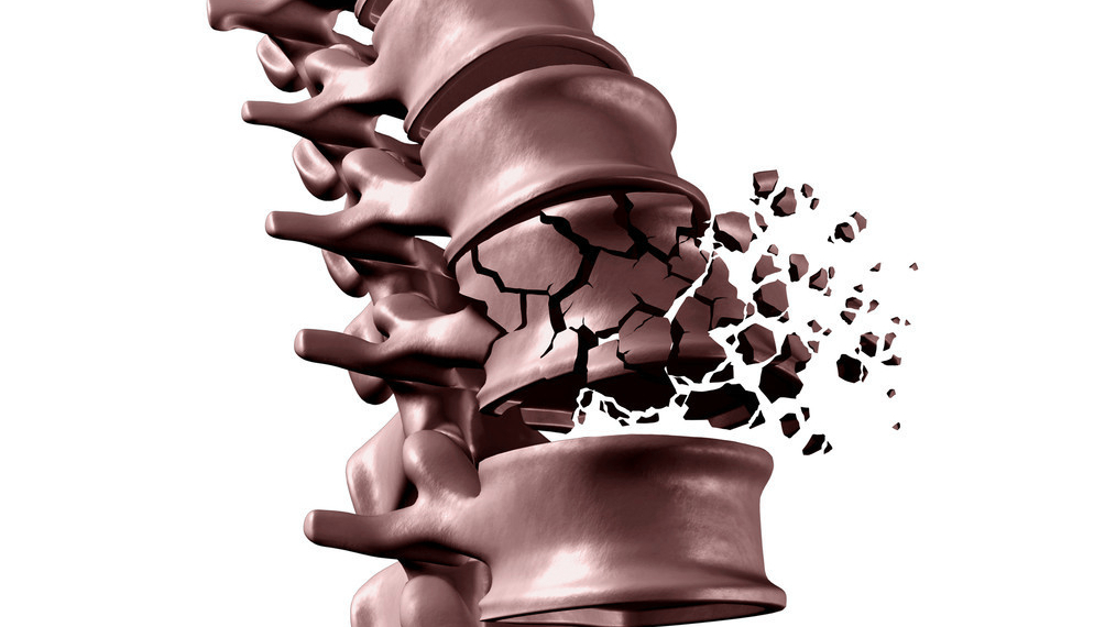 腰椎压缩性骨折保守100天能坐多久,腰椎骨折保守治疗100天可以弯腰吗