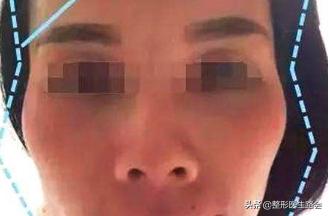 颧骨高容易变成菱形脸吗,颧骨高显得老