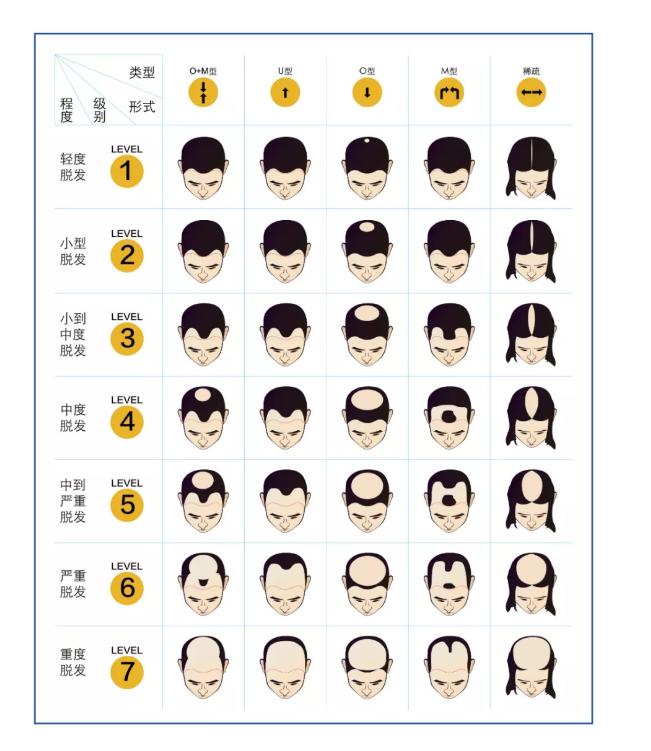 来,对照脱发等级图,你属于几级脱发了?应该如何补?