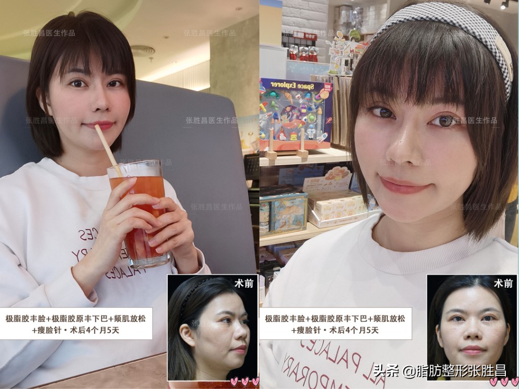 34岁广东女生，颧骨突出显刻薄苦相，脂肪填充后美成人间富贵花