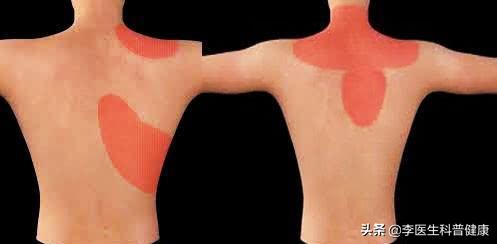 你有肩颈痛的症状吗,肩膀疼的原因和解决方法